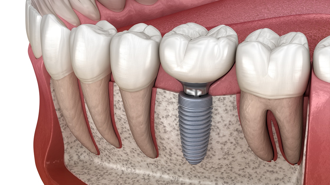 Implant Dentar
